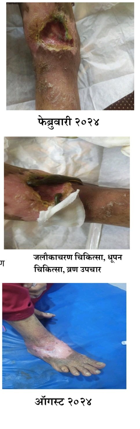 शासकीय आयुर्वेद महाविद्यालय व रुग्णालय शिरसोली रोड, जळगाव येथील शल्यतंत्र विभागात दुर्धर व जुनाट जखमेवर आयुर्वेद पद्धतीने यशस्वी उपचार