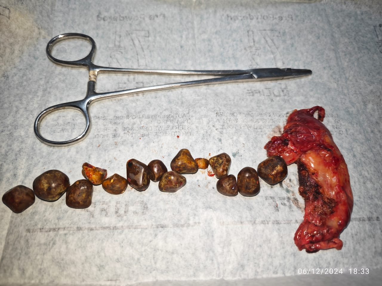 नर्मदा मेडिकल फाउंडेशनमधील यशस्वी पित्ताशयाचे ऑपरेशन